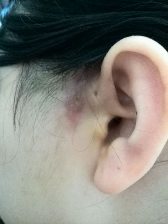 成都民生耳鼻喉提醒:耳朵旁的小孔不要挤!耳前瘘管感染后果严重